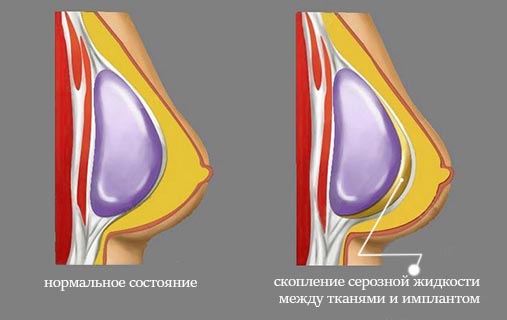 seroma after mammoplasty