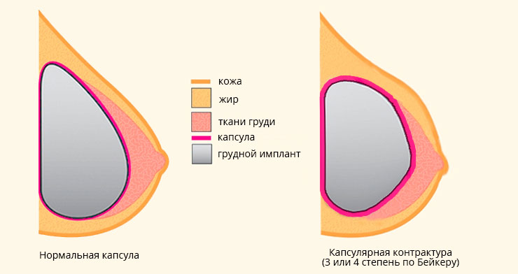 сравнение нормальной капсулы и капсулярной контрактуры 3 и 4-й степени