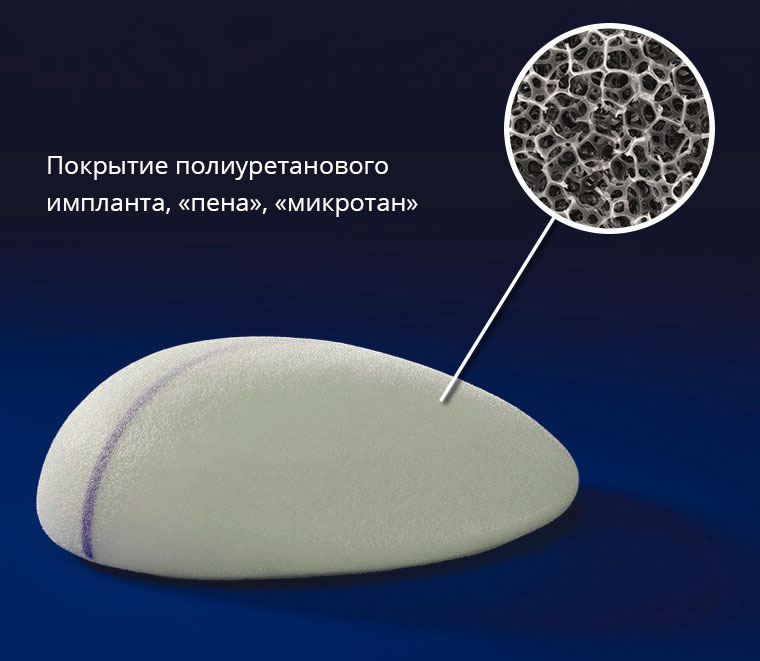 Микрополиуретановое покрытие имплантата