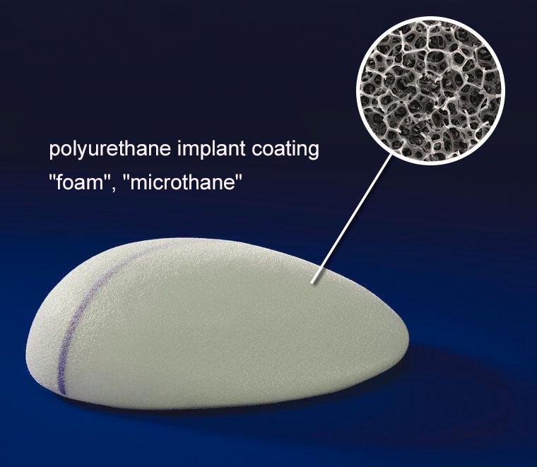 Micro-polyurethane coating of the implant