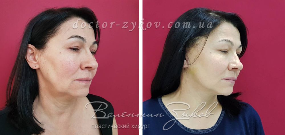 Кругова підтяжка обличчя і шиї, через 2 тижні Кругова підтяжка обличчя і шиї, через 2 тижні