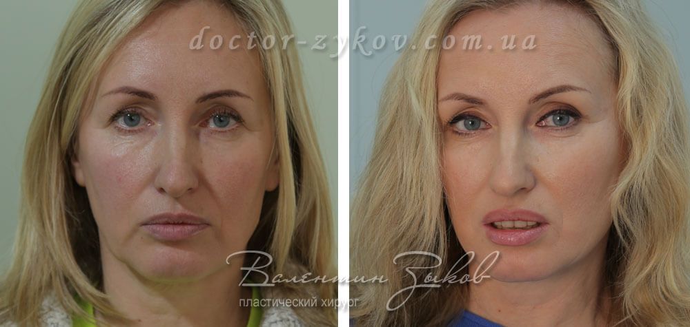 Скронева підтяжка обличчя, через 3 години після операції Скронева підтяжка обличчя, через 3 години після операції
