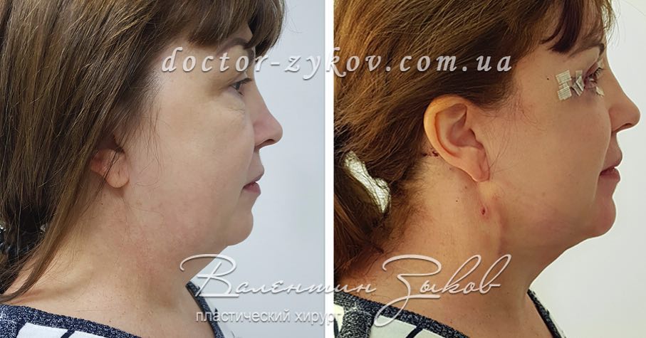 Підтяжка шиї без швів. Авторська методика. Поєднання ліпосакції з підтяжкою нитками в одній операції Підтяжка шиї без швів. Авторська методика. Поєднання ліпосакції з підтяжкою нитками в одній операції