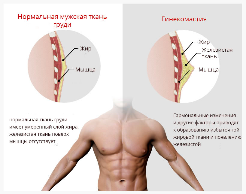 гинекомастия и нормальная мужская грудь гинекомастия и нормальная мужская грудь