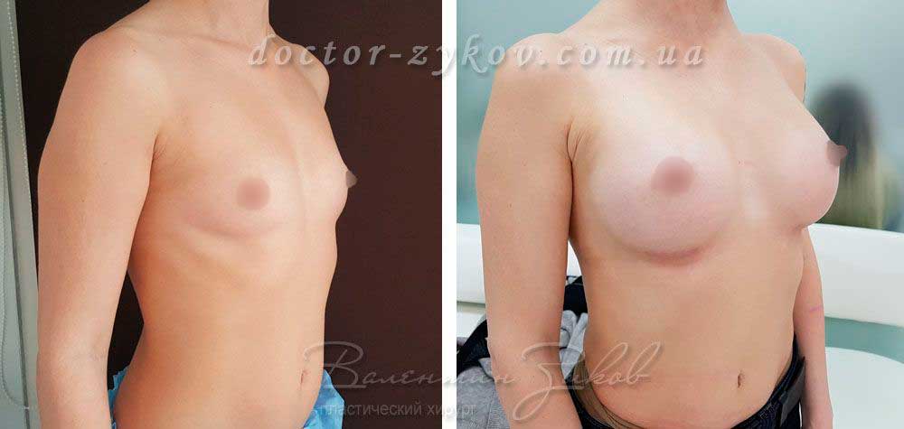 Anatomical polyurethane implants Polytech 275 cc, 2 months after mammoplasty