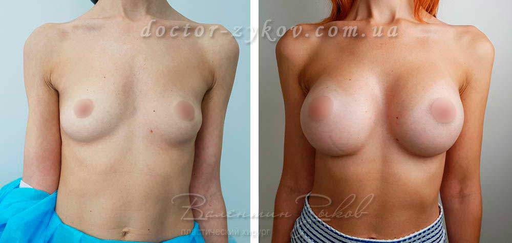 Polyurethane anatomical implants Polytech 425 cc. Breast Augmentation Result