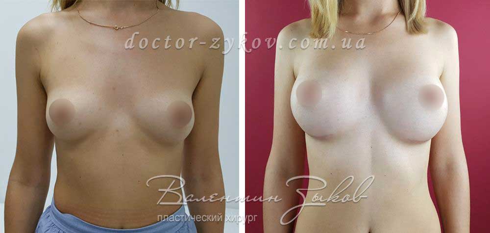 Anatomical polyurethane Polytech implants 350 cc, 1 month post-op