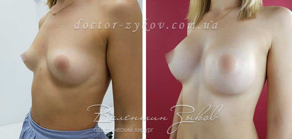 Anatomical polyurethane Polytech implants 350 cc, 1 month post-op