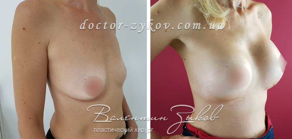 Anatomical polyurethane implants Polytech 425 cc, 10 days after surgery