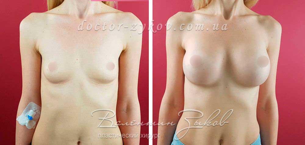 Breast augmentation with Polytech 315 cc anatomical polyurethane implants