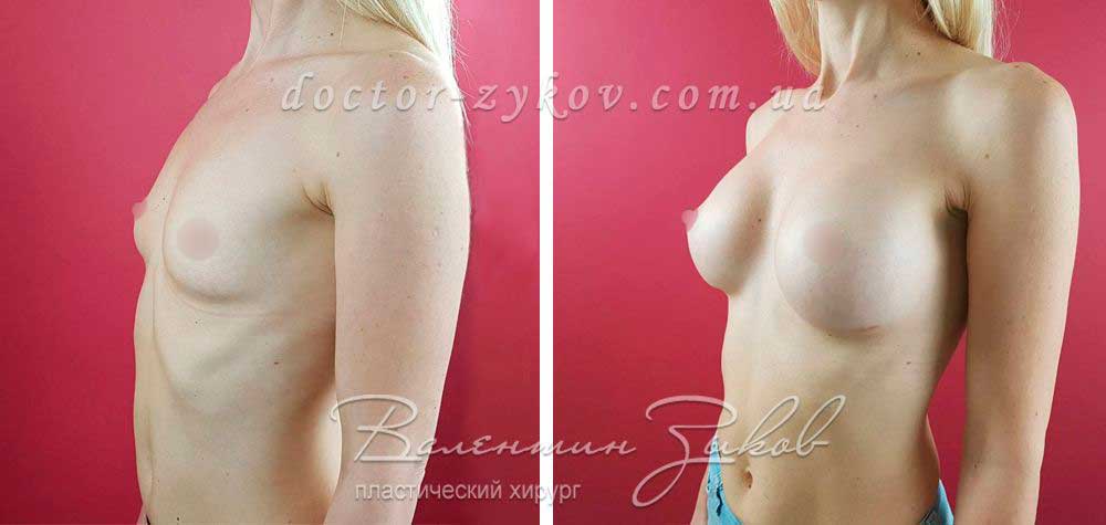 Anatomical polyurethane implants Polytech 315 cc, under the muscle