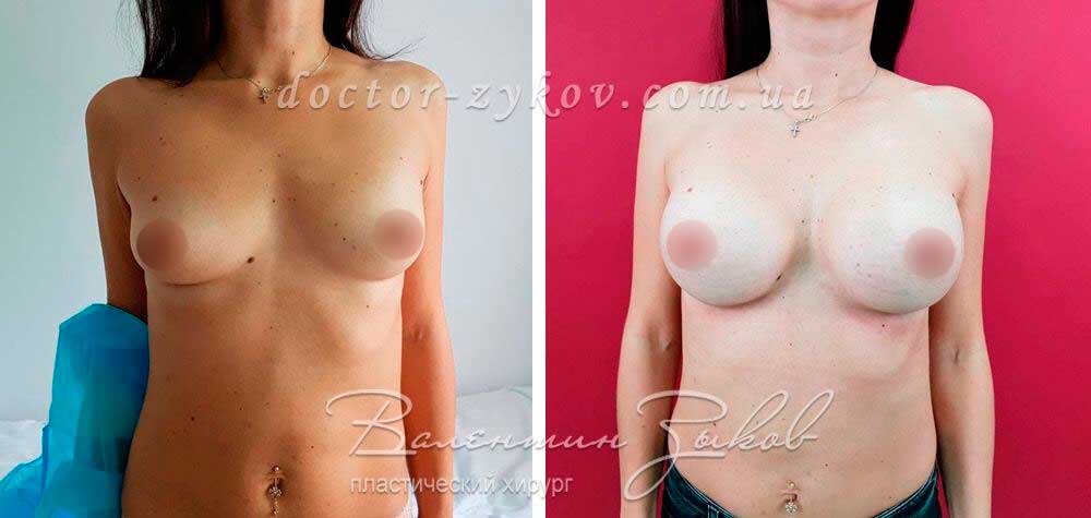 335 cc Allergan teardrop-shaped implants. 1 month after surgery