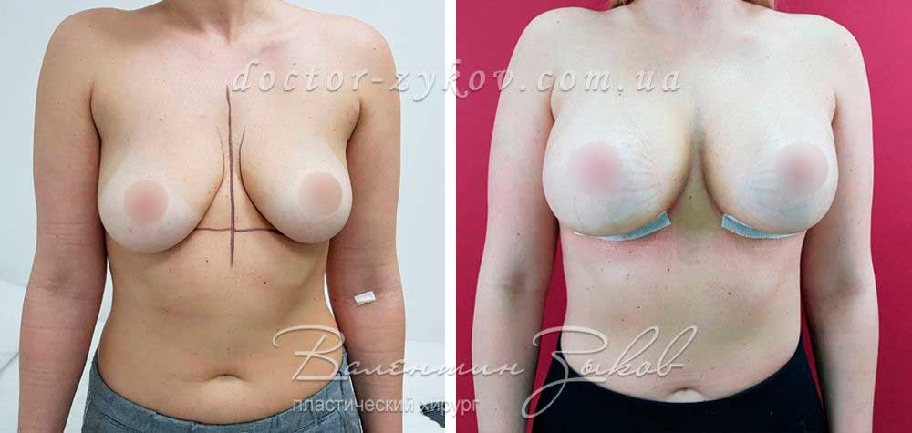 Breast augmentation with 370 cc Allergan teardrop-shaped Implants. 5 days post-op