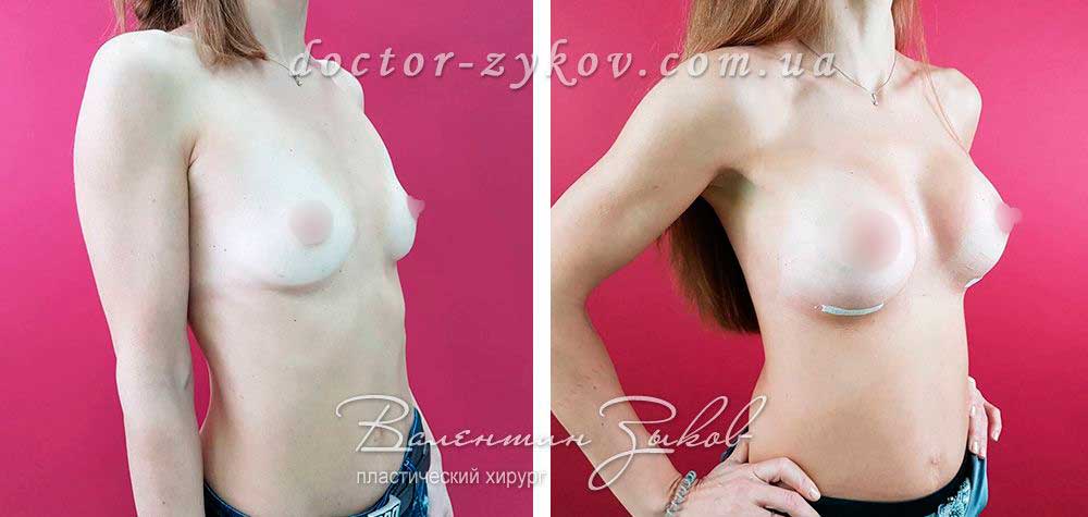 350 cc Polytech polyurethane teardrop implants, 7 days post-op. Under the muscle. Absorbable stitches
