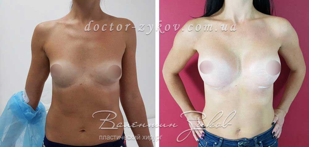 350 cc Polytech polyurethane teardrop implants, high profile, under the muscle, after 10 days