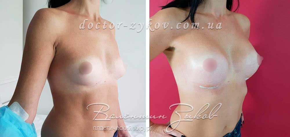 350 cc Polytech polyurethane teardrop implants, high profile, under the muscle, after 10 days