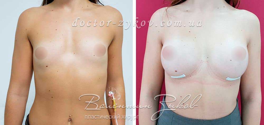 350 cc Polytech polyurethane teardrop implants. Under the muscle. High profile