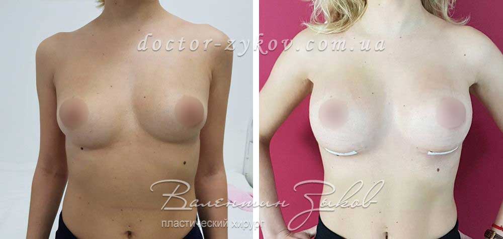 315 cc polyurethane, teardrop-shaped, high profile Implants