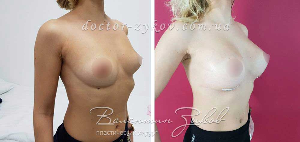 315 cc polyurethane, teardrop-shaped, high profile Implants
