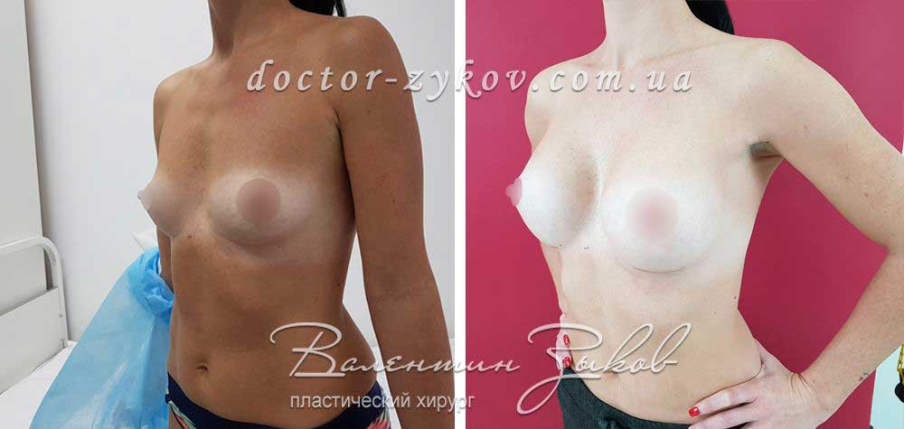 Implants Polytech polyurethane 350 cc, under the muscle, 2 months after surgery