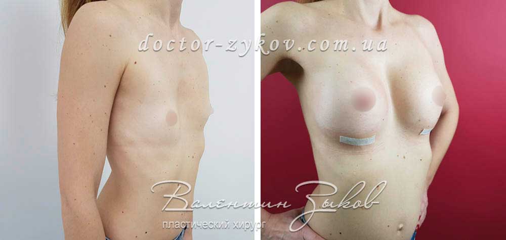 In the right chest 400 cc round in the left one - 350 cc teardrop-shaped anatomical Polytech polyurethane, under muscle