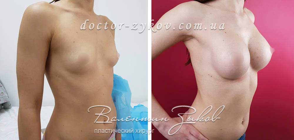 350 cc anatomical teardrop-shaped Polytech implants, under the muscle, 4 months post-op