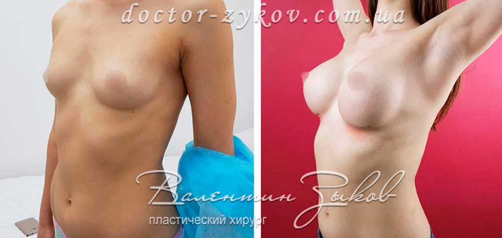 350 cc anatomical teardrop-shaped Polytech implants, under the muscle, 4 months post-op