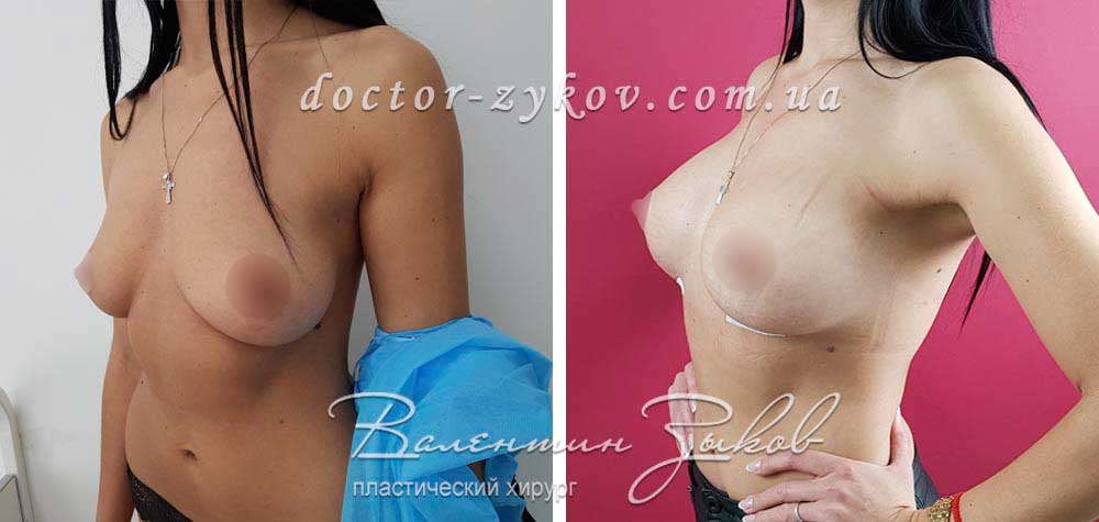 335 cc Allergan anatomical teardrop implants, under the muscle, 7 days post-op