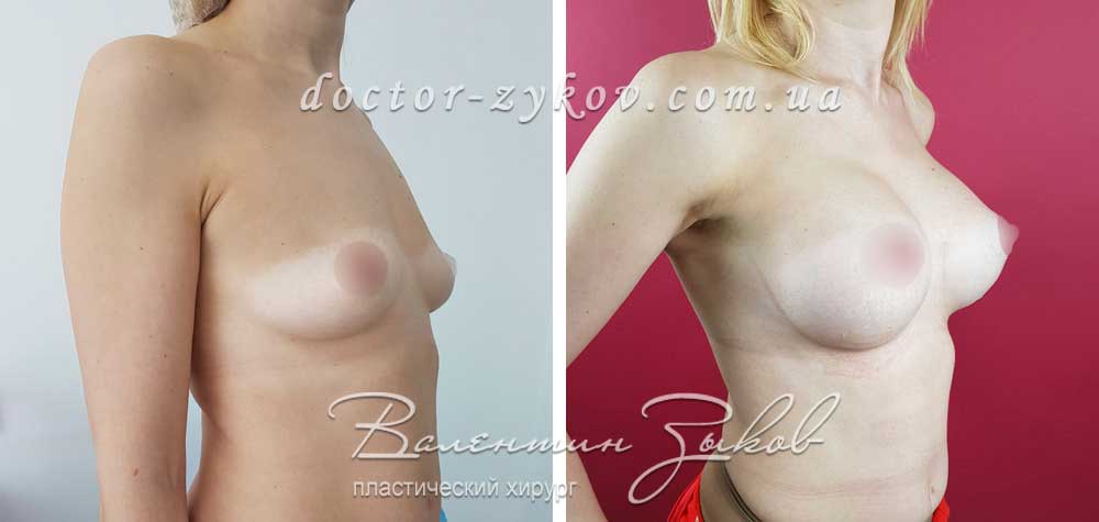 425 cc Polytech polyurethane teardrop-shaped anatomical implants, under the muscle. 1 month post-op