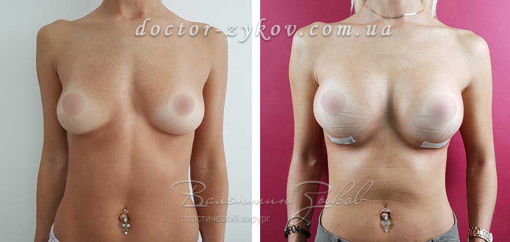 320 cc Polytech polyurethane teardrop implants, under the muscle