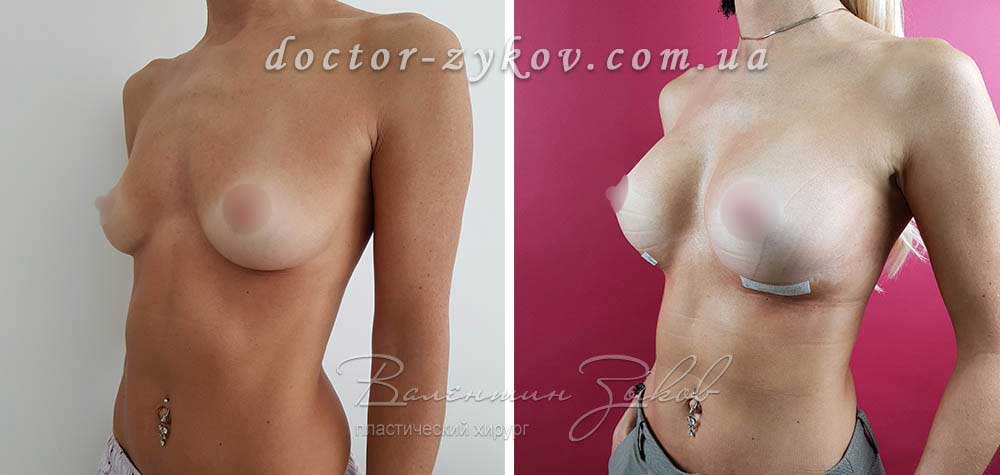 320 cc Polytech polyurethane teardrop implants, under the muscle