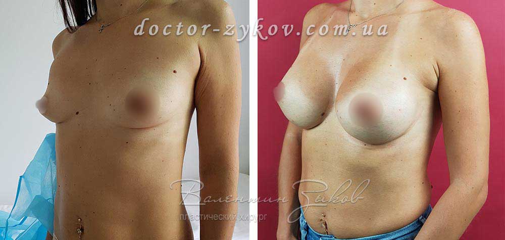 335 cc Allergan teardrop implants, 6 months post-op
