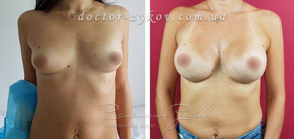 335 cc Allergan teardrop implants, 6 months post-op
