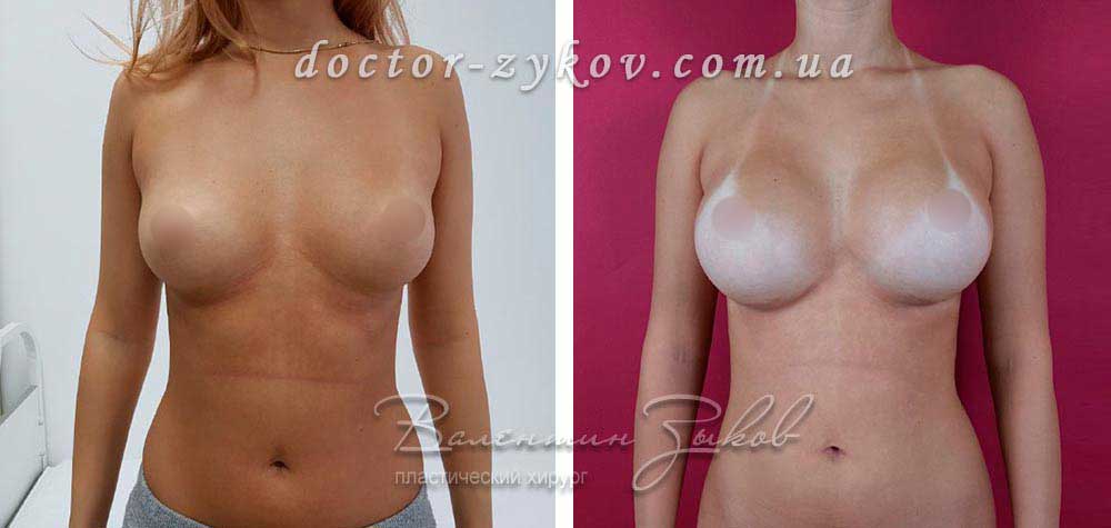 425 cc Polytech polyurethane anatomical drop-shaped. Under the muscle, 6 months post-op