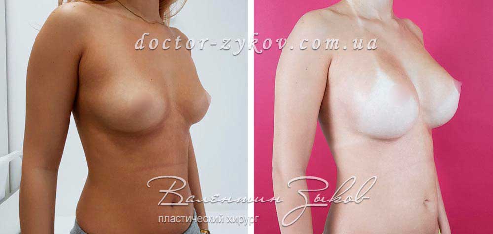 425 cc Polytech polyurethane anatomical drop-shaped. Under the muscle, 6 months post-op