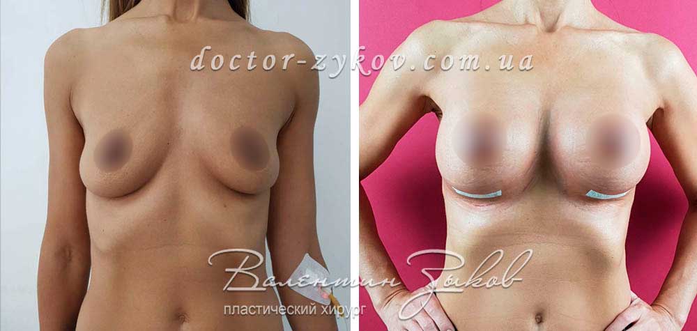 425 cc Polytech polyurethane drop-shaped implants. 6 days post-op