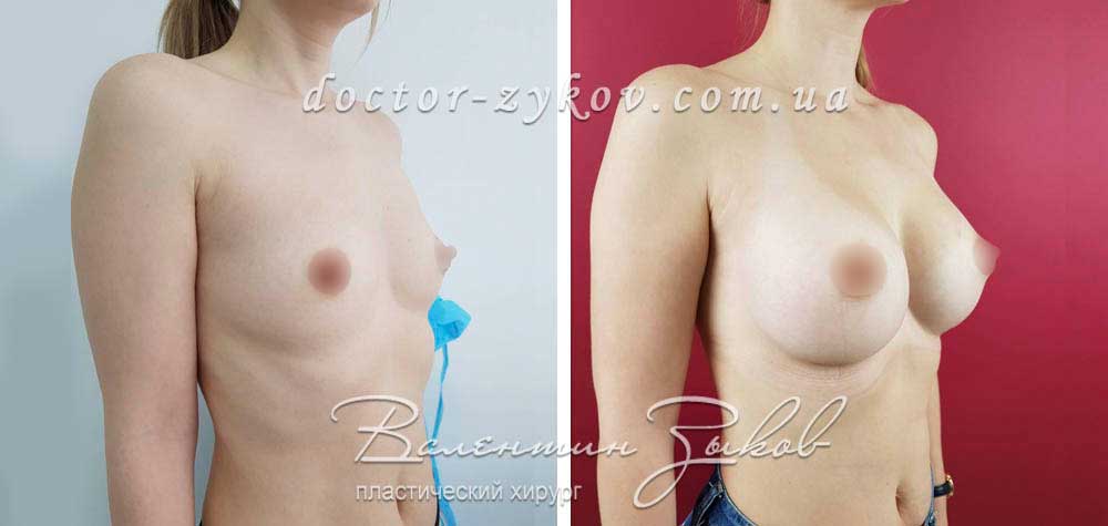 350 cc Polytech Polyurethane Anatomical implants, under the muscle.  2 months post-op