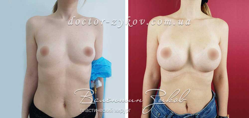350 cc Polytech Polyurethane Anatomical implants, under the muscle.  2 months post-op