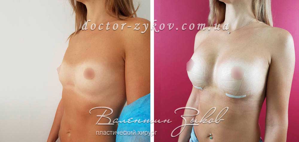 395 cc Polytech polyurethane anatomical implants, under the muscle.  7 days post-op