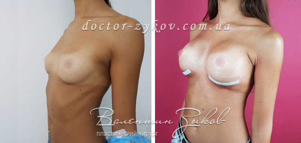 395 cc Polytech polyurethane anatomical implants, under the muscle, 6 days post-op
