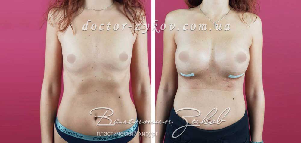 395 cc Polytech polyurethane under the muscle, 7 days post-op