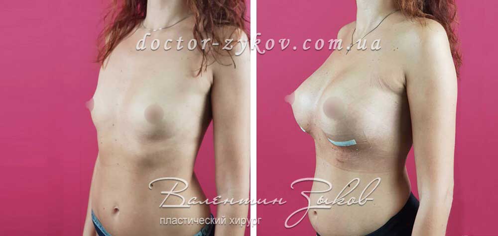 395 cc Polytech polyurethane under the muscle, 7 days post-op