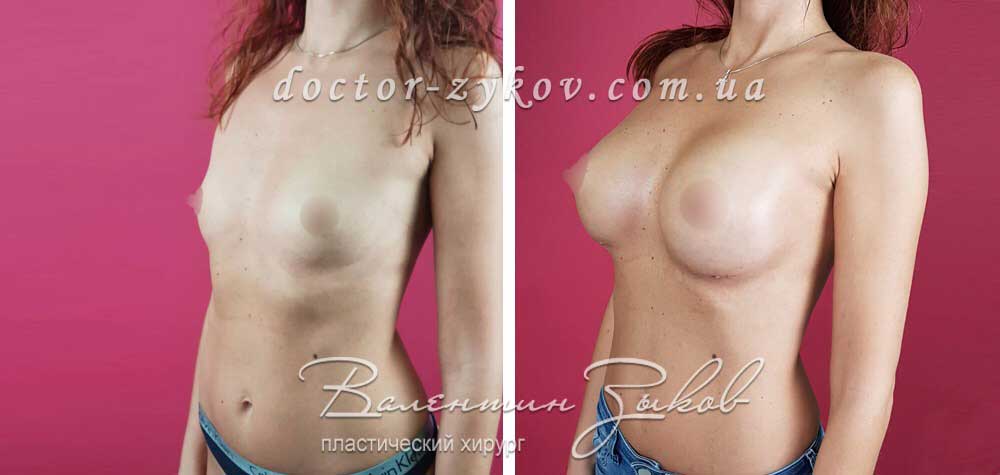395 cc, Polytech polyurethane under the muscle, 2 weeks post-op
