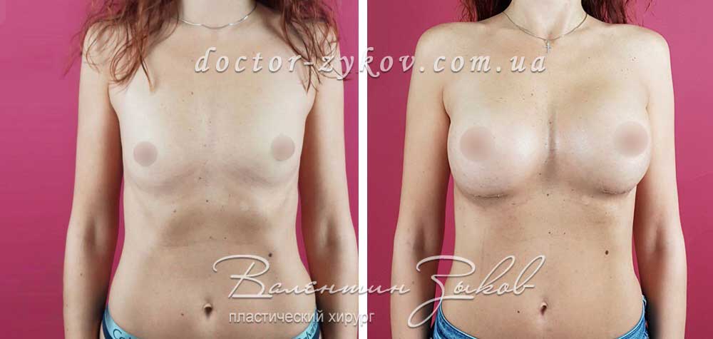 395 cc, Polytech polyurethane under the muscle, 2 weeks post-op