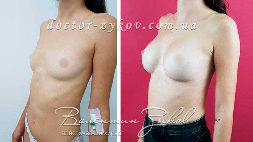 320 cc Polytech polyurethane anatomical implants, under the muscle, 2 months post-op