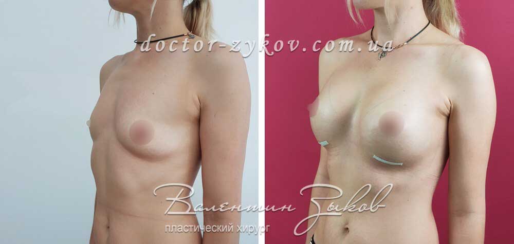 350 cc Polytech polyurethane anatomical implants, under the muscle, 7 days post-op