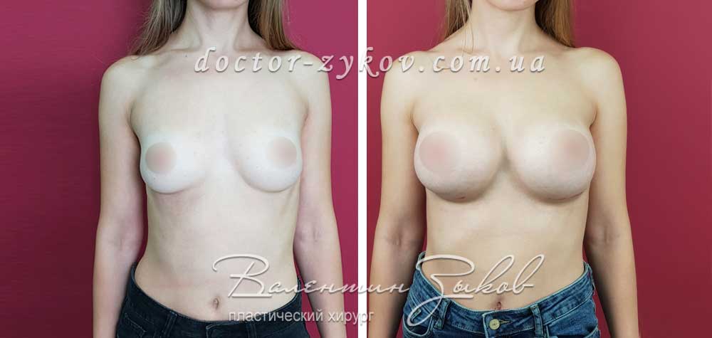 395 cc Polytech polyurethane anatomical under the muscle, 1 month post-op