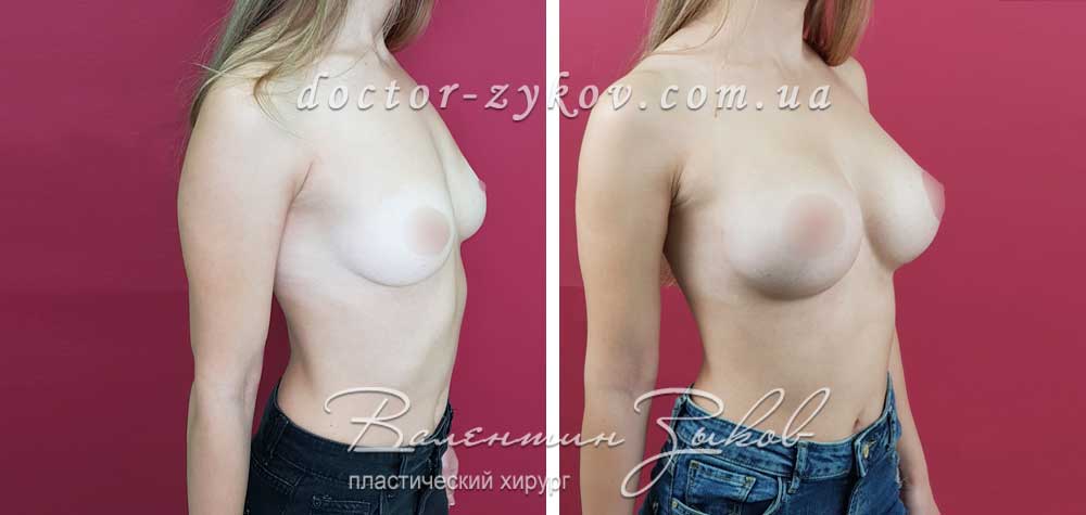 395 cc Polytech polyurethane anatomical under the muscle, 1 month post-op