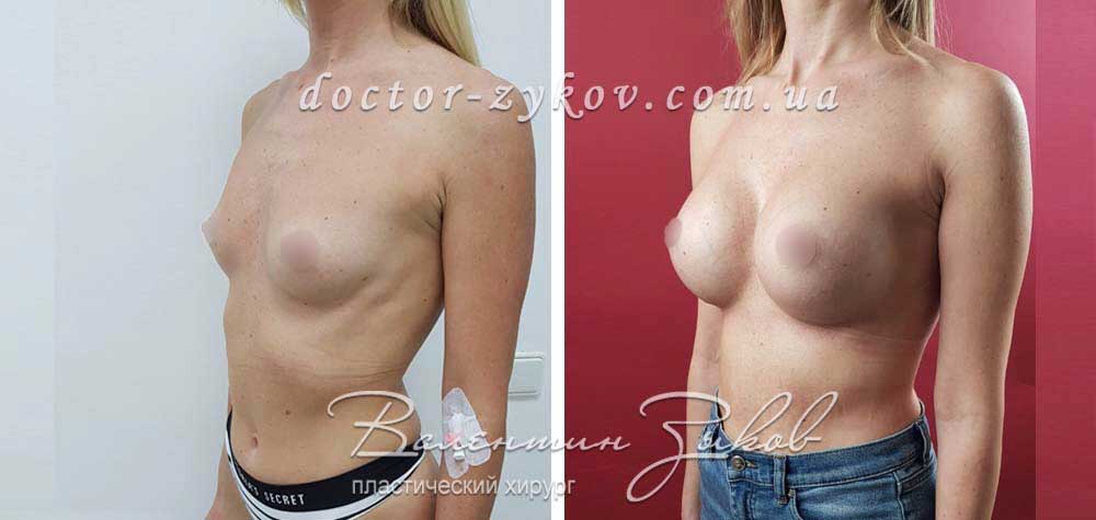 Breast Implants 350 cc Polytech polyurethane anatomical, 2 months post-op