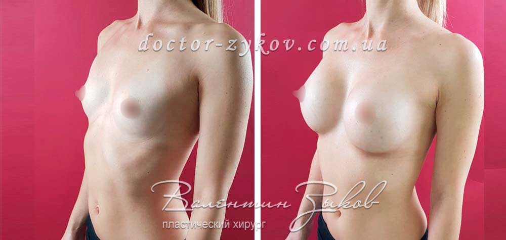 395 cc Polytech polyurethane anatomical, under the muscle, 2 months post-op